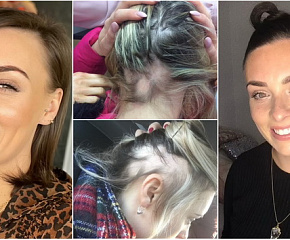 devojka-iz-irske-objavila-je-iskrene-fotografije-kako-izgleda-alopeacija-za-5-godina-izgubila-je-80-kose-01.jpg