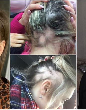 devojka-iz-irske-objavila-je-iskrene-fotografije-kako-izgleda-alopeacija-za-5-godina-izgubila-je-80-kose-01.jpg