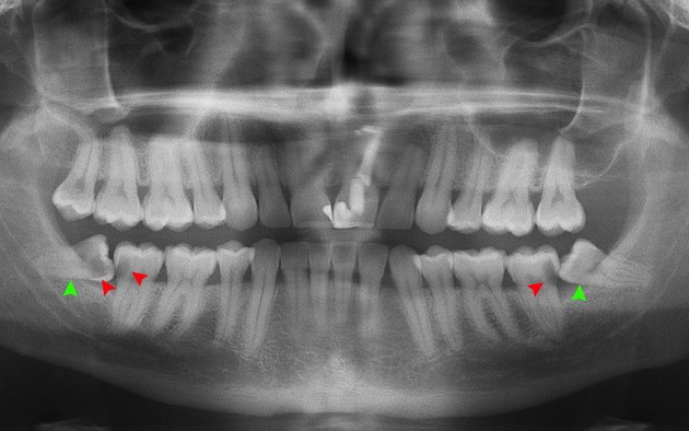 razdvojeni-zubi-i-jos-7-retkih-karakteristika-koje-mozda-imate-i-vi-07.jpg