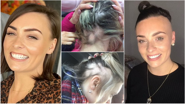 devojka-iz-irske-objavila-je-iskrene-fotografije-kako-izgleda-alopeacija-za-5-godina-izgubila-je-80-kose-01.jpg